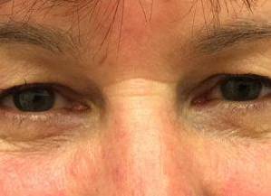 Blepharoplasty Case 3 Before