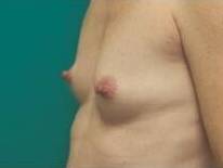 Breast Augmentation Case 1 Before