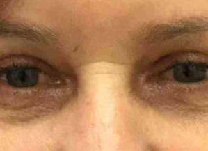 Blepharoplasty Case 3 After