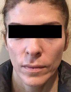 Laser Skin Resurfacing Case 1 After