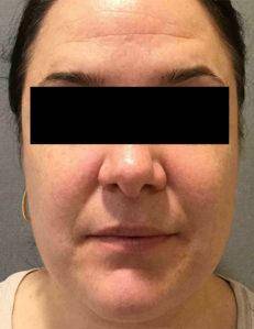 Laser Skin Resurfacing Case 2 Before