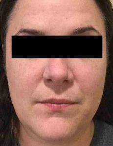 Laser Skin Resurfacing Case 2 After