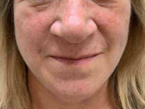 Laser Skin Resurfacing Case 3 After