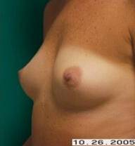 Breast Augmentation Case 3 Before