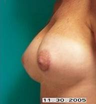 Breast Augmentation Case 3 After