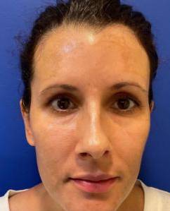 Laser Skin Resurfacing Case 4 Before