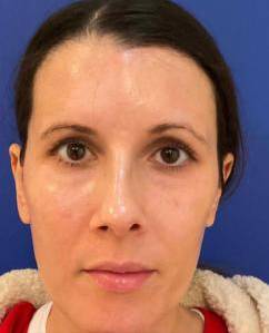 Laser Skin Resurfacing Case 4 After