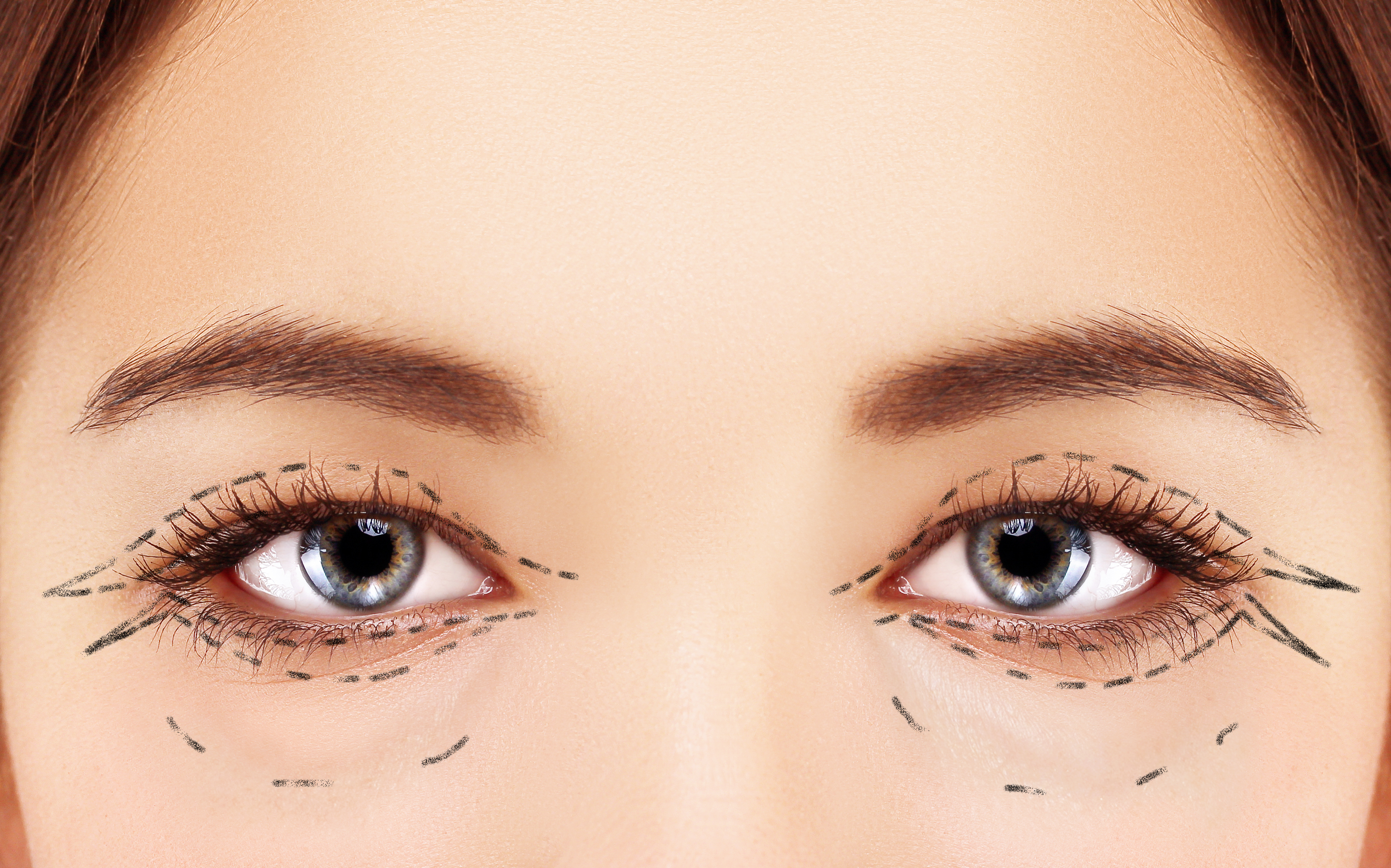 Tips For Successful Recovery After Eyelid Surgery